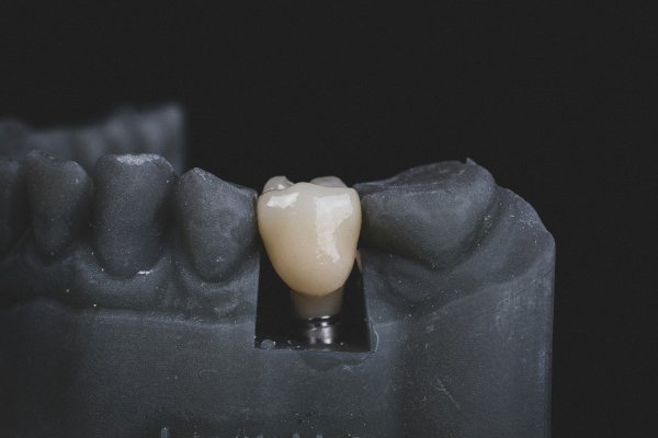 article cover - Dental Implants Market Size, Share, Growth Factors and...