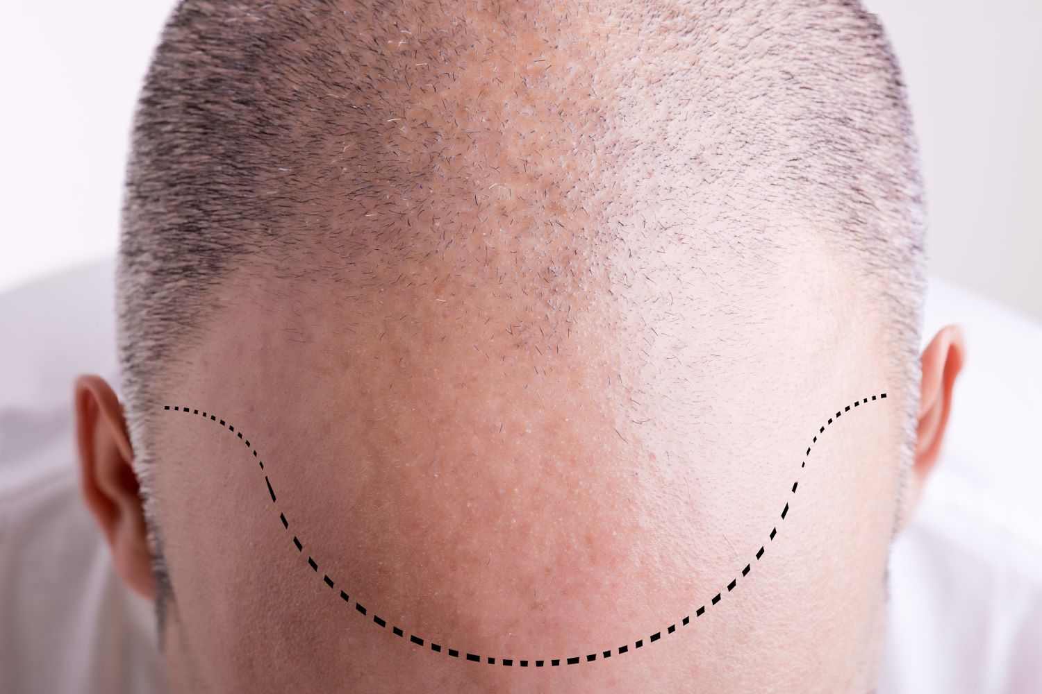 article cover - London Hair Transplant: A Revolutionary Way to Restore...